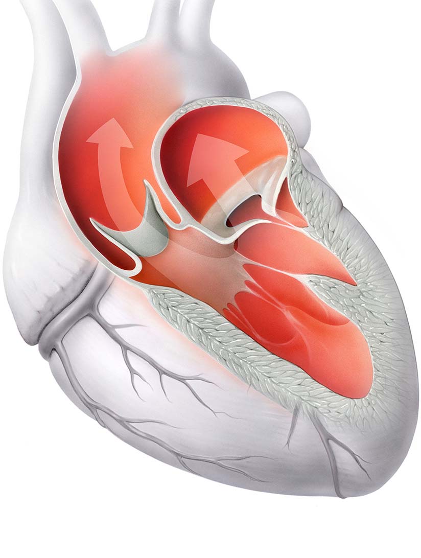 Heart valve diseases