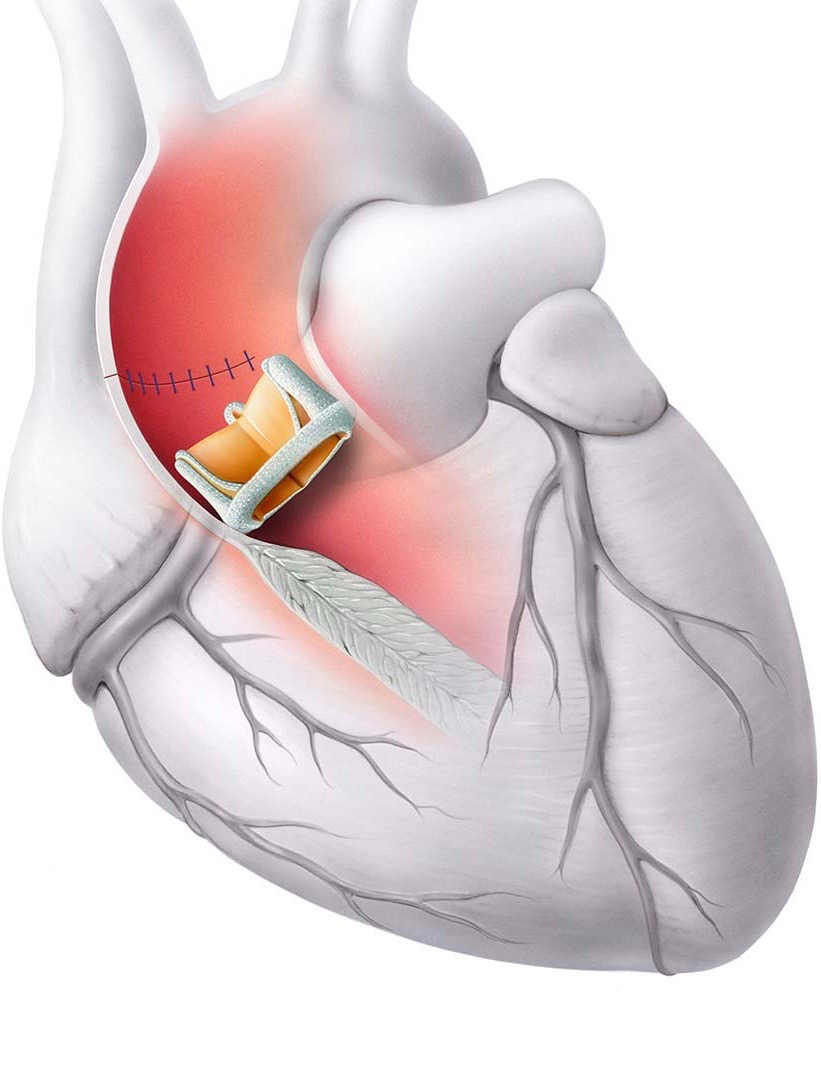 Aortenklappen-Prothese
