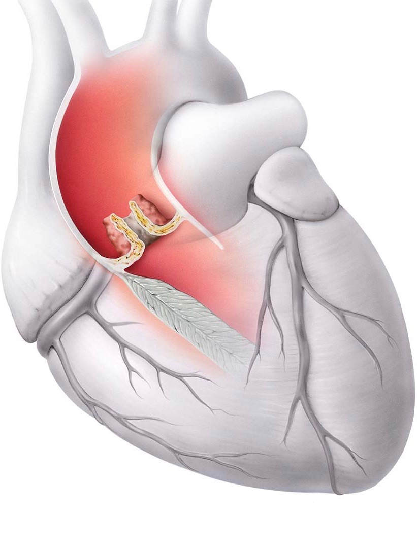 Aortenstenose-Herzklappen